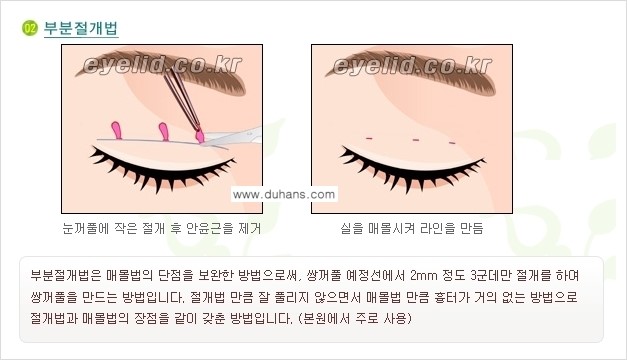 [두한성형외과 경쟁력 눈성형] - [퀵쌍꺼풀(부분절개법) 수술 안내] 관련 이미지 8