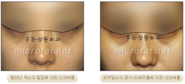[두한성형외과 지방이식] - [다크써클, 눈​밑주름] 관련 이미지 2