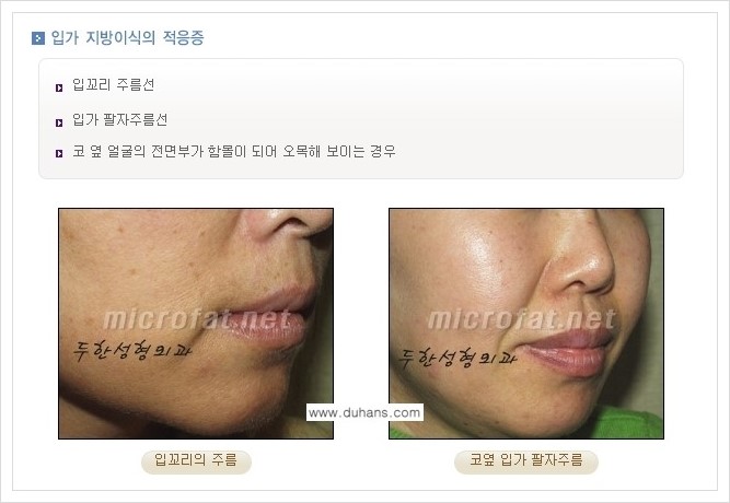 [두한성형외과 경쟁력 지방이식] - [입가주름, 팔자주름 미세지방이식의 안내] 관련 이미지 2