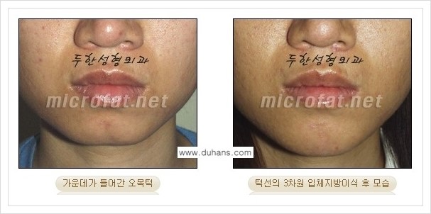 ⁠⁠[두한성형외과 경쟁력 미세지방이식] - [턱 미세지방이식 - 안면윤곽 교정 안내] 관련 이미지 12