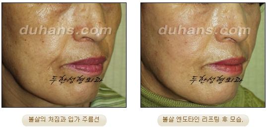 두한성형외과 안티에이징 리프팅 - 엔도타인 리프팅 관련 이미지 16