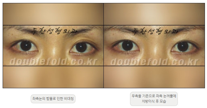 [두한성형외과 쌍커플재수술] - [비대칭 쌍커풀 라인] 관련 이미지 19