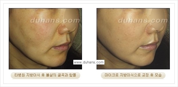 [두한성형외과 경쟁력 얼굴 미세지방이식] - [타병원에서 지방이식 후 굴곡과 과주입 교정 안내] 관련 이미지 2