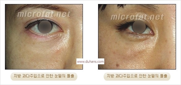 [두한성형외과 경쟁력 미세지방이식] - [타 병원의 지방이식 부작용 교정 - 정교한 마이크로 지방이식, 흡입 안내] 관련 이미지 5
