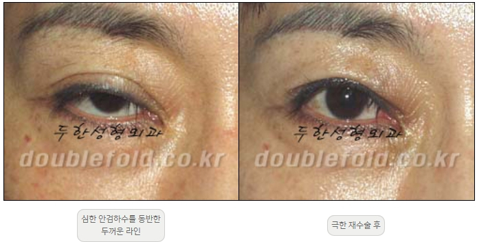 [Duhan Plastic Surgery Double Eyelid Revision] - [Thick Double Eyelid Line] image 35