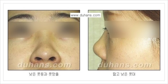 [두한성형외과 경쟁력 미세지방이식] - [자연스러운 코높임 지방이식 안내 ①] 관련 이미지 4