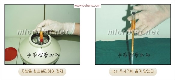 [두한성형외과 경쟁력 눈성형 리더] - [윗눈꺼풀 함몰( #꺼진눈꺼풀) 미세지방이식과 상안검성형]#꺼진눈성형 , #눈위함몰 관련 이미지 6