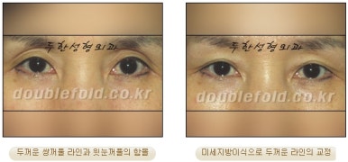 [두한성형외과 쌍커풀수술] - [쌍꺼풀지방이식] 관련 이미지 25
