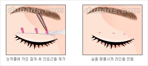 [두한성형외과 경쟁력 눈성형] - [자연스럽고 아름다운 눈매를 위한 쌍꺼풀 수술 ①] 관련 이미지 3