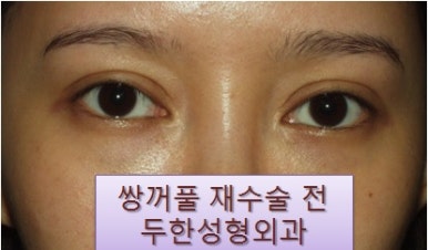 [두한성형외과 쌍커풀재수술] - [심한 소세지눈, 두줄따기, 쌍꺼풀 흉터] 관련 이미지 30