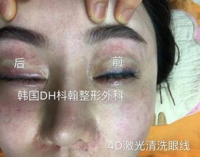 Duhan Plastic Surgery Laser Treatment - Mole Removal, Spot Removal, Melasma, Blemishes, Hyperpigmentation, Skin Tone Improvement, Elasticity Improvement, Skin Texture Improvement image 14