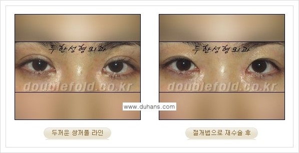 [두한성형외과 경쟁력 쌍꺼풀 재수술] - [두껍고 어색한 라인 교정하는 방법 안내 2.] 관련 이미지 5