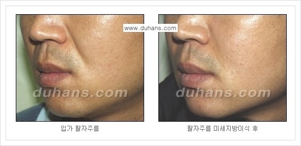​[두한성형외과 경쟁력 주름성형] - [주름교정을 위한 미세지방이식 안내 2.] 관련 이미지 5