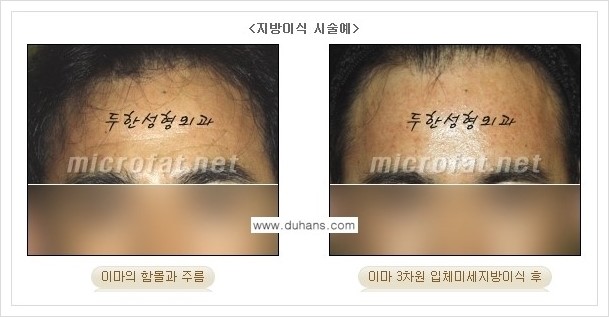 ⁠[두한성형외과 경쟁력 미세지방이식] - [상표등록 "Col-fat(콜펫) 지방이식"으로 교정이 가능한 부위] 관련 이미지 3