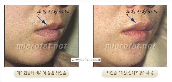 [두한성형외과 경쟁력 미세지방이식] - [입술 3차원 입체지방이식 안내 1.] 관련 이미지 15