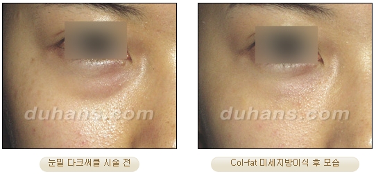[Duhan Plastic Surgery Facial Autologous Fat Grafting] - [Fat Grafting Guide] image 23