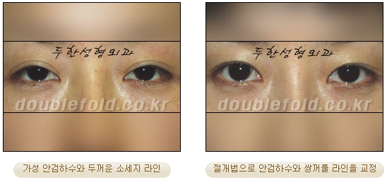 [Duhan Plastic Surgery Secondary Double Eyelid Surgery] - [Sleepy Eye Appearance, Asymmetrical Eye Appearance, Ptosis] image 14