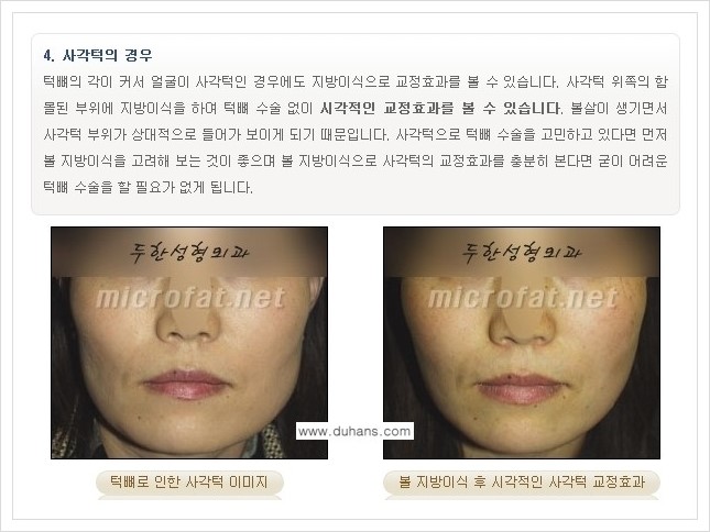 [두한성형외과 경쟁력 볼살지방이식] - [사각턱의 경우, 측면 볼살의 함몰선, 안면비대칭, 남성 야윈볼살 안내] 관련 이미지 1