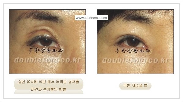 [두한성형외과 경쟁력 쌍꺼풀 재수술, 극한 눈재수술] - [쌍꺼풀 재수술, 극한 눈재수술 관련 자주하는 질문과 답변] 관련 이미지 3