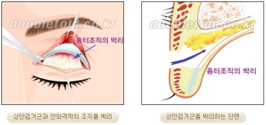 [Duhan Plastic Surgery Double Eyelid Revision Surgery] - [Ptosis, sausage eyelids] image 11