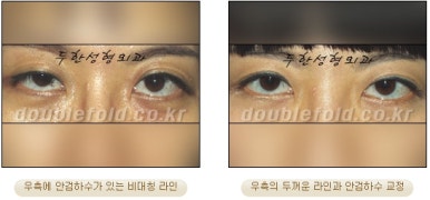 [Duhan Plastic Surgery Eye Surgery] - [Asymmetric Line, Eyelash Eversion, Deep Fixation] image 8