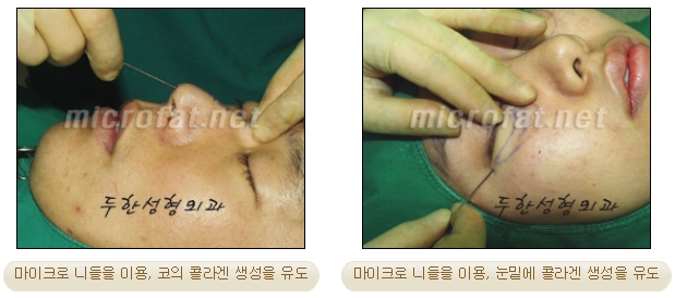 [두한성형외과 미세지방이식] - [자가지방이식] 관련 이미지 5