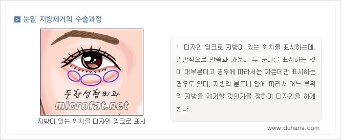 [두한성형외과 경쟁력 지방제거] - [눈밑(눈위)지방제거, 눈꺼풀(윗눈꺼풀)지방제거 안내 ①] 관련 이미지 5
