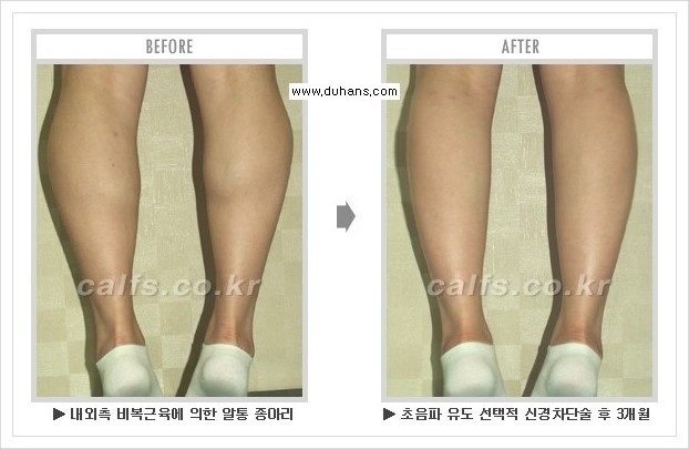 [두한성형외과 경쟁력 멀티종아리성형] - [종아리성형 방법별 전후 주의사항] 관련 이미지 18