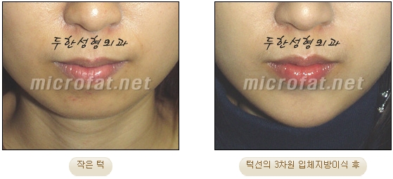 [두한성형외과 미세지방이식] - [무턱교정 안내] 관련 이미지 23