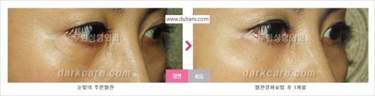 [두한성형외과 경쟁력 눈밑성형] - [눈밑 푸른 혈관 치료방법] 관련 이미지 12
