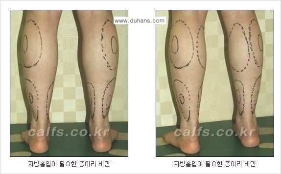 [두한성형외과 경쟁력 멀티종아리성형] - [지방흡입이 필요한 종아리 비만] 관련 이미지 2
