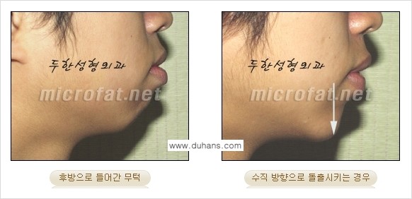[두한성형외과의 경쟁력 미세지방이식] - [무턱교정 - 턱 미세지방이식 안내 1.] 관련 이미지 6