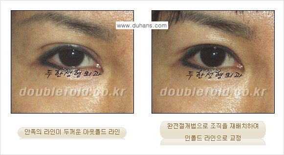 [두한성형외과 경쟁력 쌍꺼풀 재수술, 극한 눈재수술] - [심한 아웃폴드 라인을 인폴드 라인으로 교정 방법 안내] 관련 이미지 7