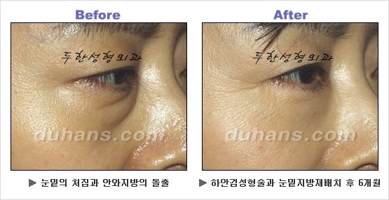 [두한성형외과 경쟁력 동안성형 리더] - ​[미간주름, 이마주름, 안검성형, 이마거상술, 눈썹거상술] 관련 이미지 75