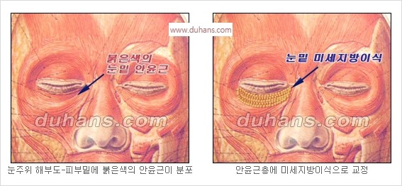 [두한성형외과 경쟁력 안검성형] - [젊은 눈매 안검성형의 여러 가지 방법 안내] 관련 이미지 62