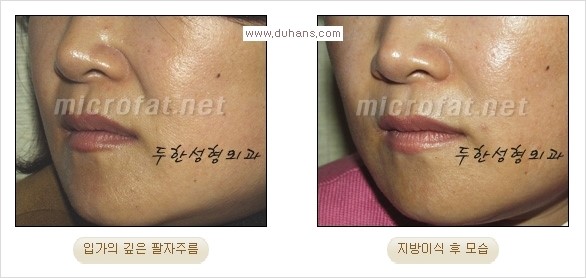 [두한성형외과 경쟁력 주름성형] - [코 옆과 입가에 걸쳐서 형성된 주름을 교정해주는 미세지방이식] 관련 이미지 15