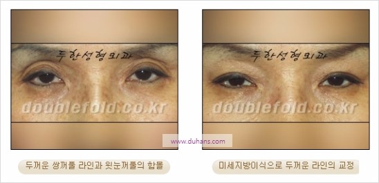 [두한성형외과 경쟁력 눈성형] - [쌍꺼풀 재수술에 대한 최선의 대안 제시] 관련 이미지 22