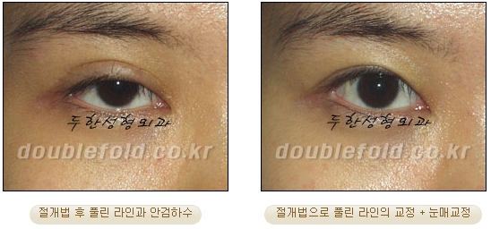 [Duhan Plastic Surgery Double Eyelid Revision Surgery] - [Ptosis Correction Surgery] image 52
