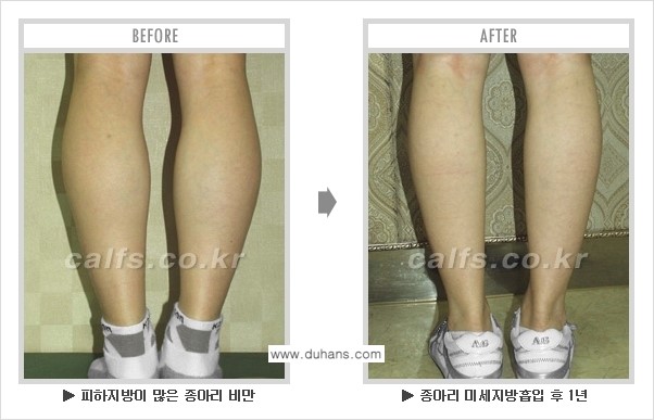 [두한성형외과 매력적인 종아리 만들기!] - [정교한 흡입 - 미세흡입관 지방흡입술 3.] 관련 이미지 9
