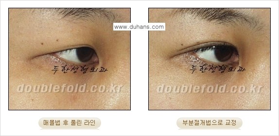 [두한성형외과 NO.1 경쟁력 눈성형] - [풀린 쌍꺼풀 절개법으로 교정하는 방법] 관련 이미지 7