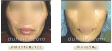 [두한성형외과 얼굴지방이식] - [볼살, 이마, 측두부] 관련 이미지 2