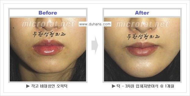 [두한성형외과 경쟁력 미세지방이식] - [미세지방이식의 시술 부위와 효과 안내] 관련 이미지 12