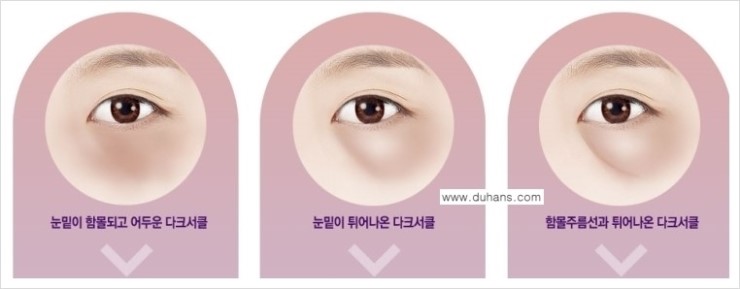 [두한성형외과 경쟁력 다크써클 치료] - [다크써클 5단계로 이뤄지는 핵심 5 STEP SOLUTION 안내 1.] 관련 이미지 10