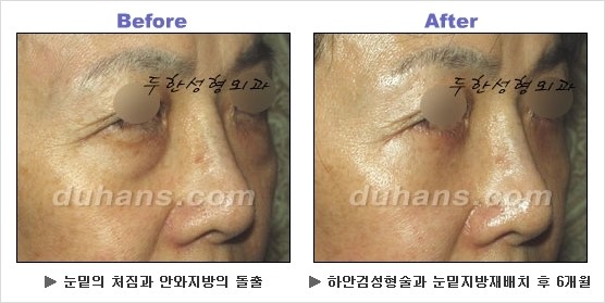 [두한성형외과 경쟁력 동안성형 리더] - ​[미간주름, 이마주름, 안검성형, 이마거상술, 눈썹거상술] 관련 이미지 94
