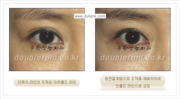 [두한성형외과 경쟁력 쌍꺼풀(눈) 재수술] - [심한 아웃폴드 라인을 인폴드 라인으로의 교정 안내] 관련 이미지 10