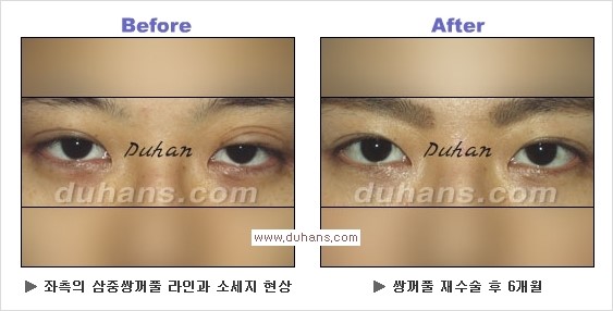 [두한성형외과 경쟁력 쌍꺼풀 재수술, 극한 눈재수술] - [과한 아웃폴드 쌍꺼풀 라인 교정 방법] 관련 이미지 3