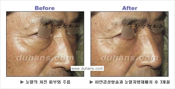 [두한성형외과의 상큼하고 환한 젊은 눈매완성] - [하안검 성형술 ②] 관련 이미지 26
