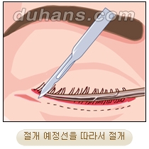 [두한성형외과 안검성형] - [상안검, 하안검] 관련 이미지 17