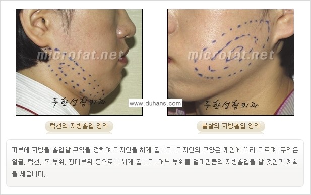 [두한성형외과 겨울엔 지방흡입을] - [통통한 볼살, 두툼한 턱선의 지방흡입 2.] 관련 이미지 2