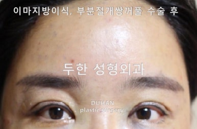 [Duhan Plastic Surgery Eye Surgery] - [Quick Double Eyelid Surgery] image 26